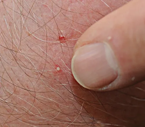 THIS WHITE BUMP is the site of a bee sting, about 20 hours old. Beekeepers generally consider stings just a part of the job. (Photo by Kathy Keatley Garvey)