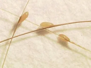 Huevecillos (liendres) de un piojo en el cabello humano