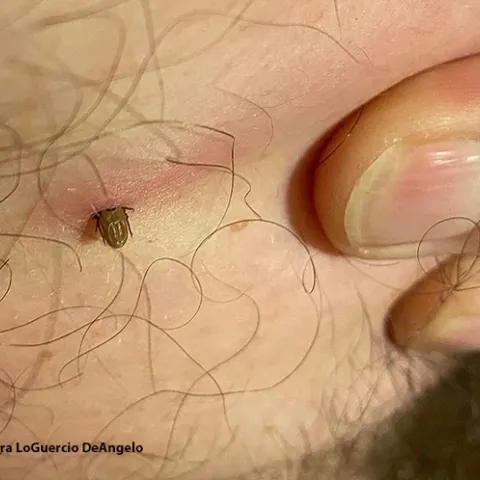 This is the tick buried in the skin of Winters' resident Joe Nazarius. It's black-legged nymph tick, Ixodes pacificus, as identified by Lynn Kimsey, director of the Bohart Museum of Entomology and a UC Davis distinguished professor of entomology. (Photo by Debra LoGuercio DeAngelo)