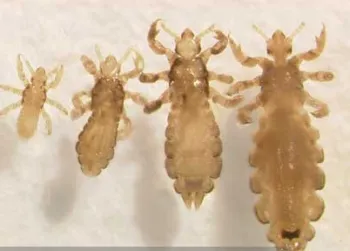 Head lice life stages. (Photo: Dr. Shujuan [Lucy] Li)