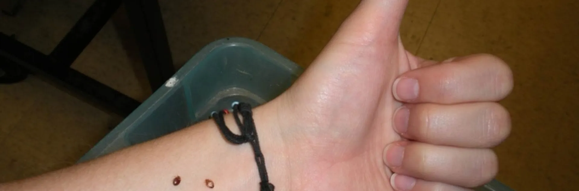 The arm of Danielle Wishon and her bedbugs, feeding.