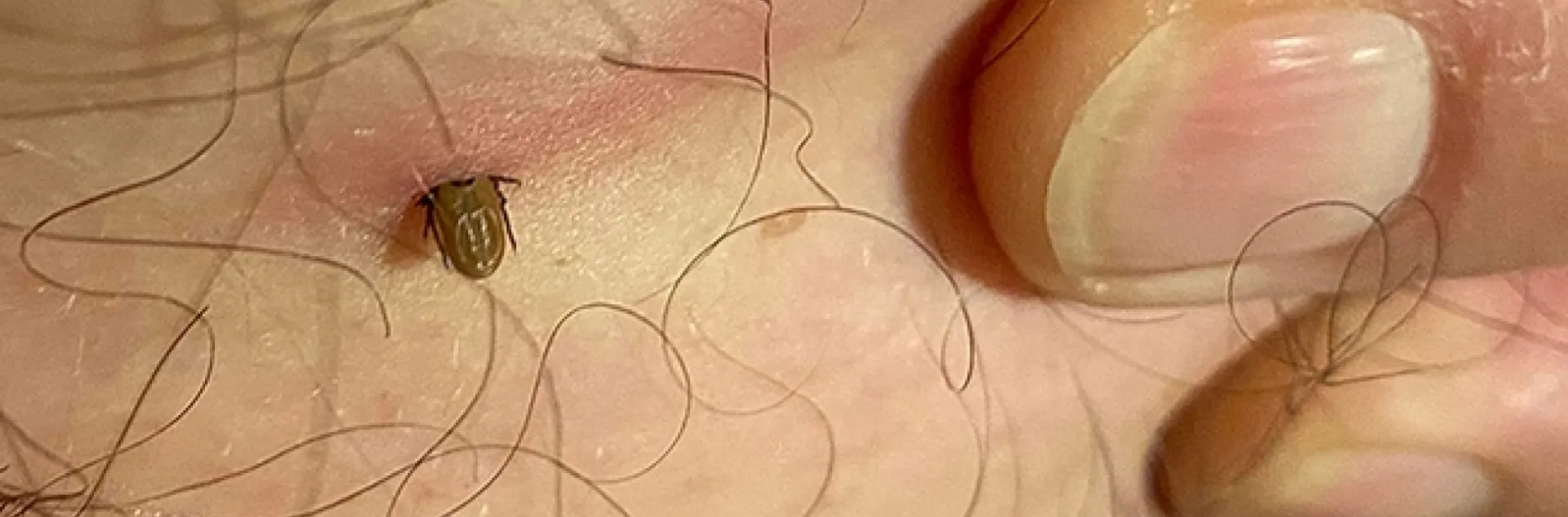 This is the tick buried in the skin of Winters' resident Joe Nazarius. It's black-legged nymph tick, Ixodes pacificus, as identified by Lynn Kimsey, director of the Bohart Museum of Entomology and a UC Davis distinguished professor of entomology. (Photo by Debra LoGuercio DeAngelo)